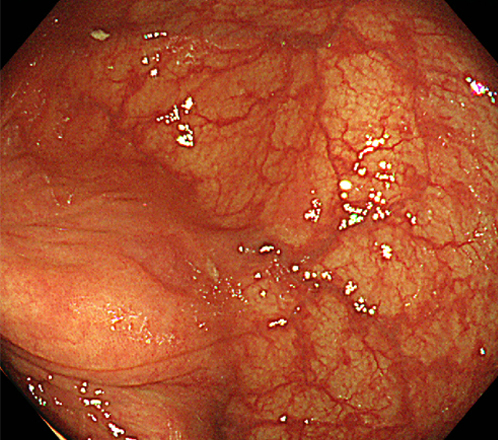 S状結腸に認められた 8mm大の陥凹型　早期大腸がん